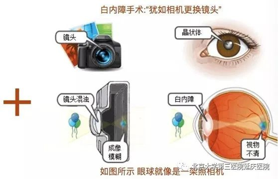 最新白内障手术科普视频，带你走进光明新世界