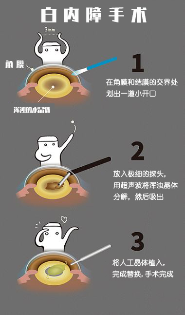 最新白内障手术科普视频，带你走进光明新世界